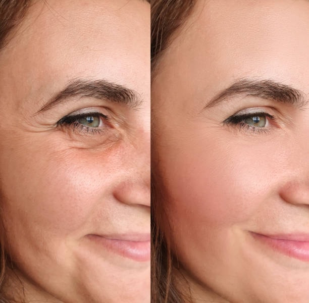 Approved patient before and after result showing natural-looking refinement