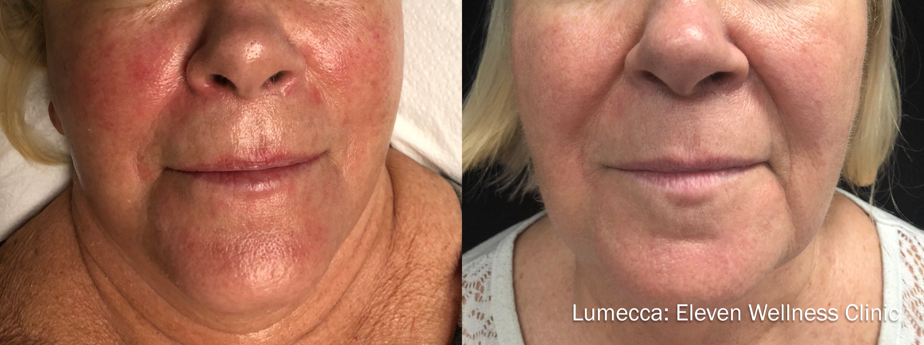 Approved patient before and after Lumecca IPL treatment showing improved skin tone and clarity