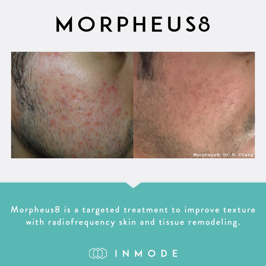 Approved patient before and after Morpheus8 treatment showing skin tightening and texture improvement
